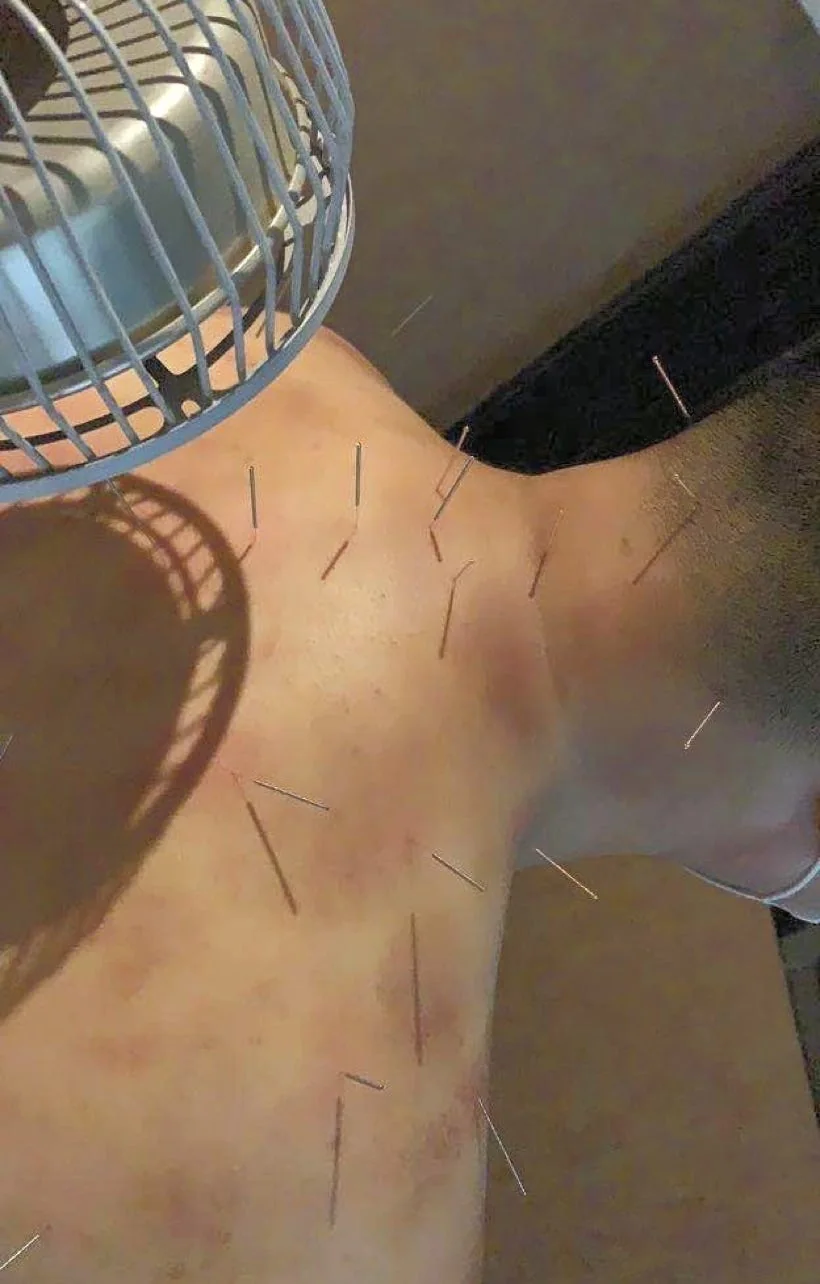 诊所进行针灸服务时使用的针具